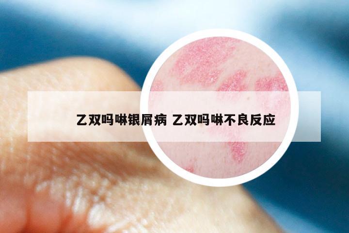 乙双吗啉银屑病 乙双吗啉不良反应