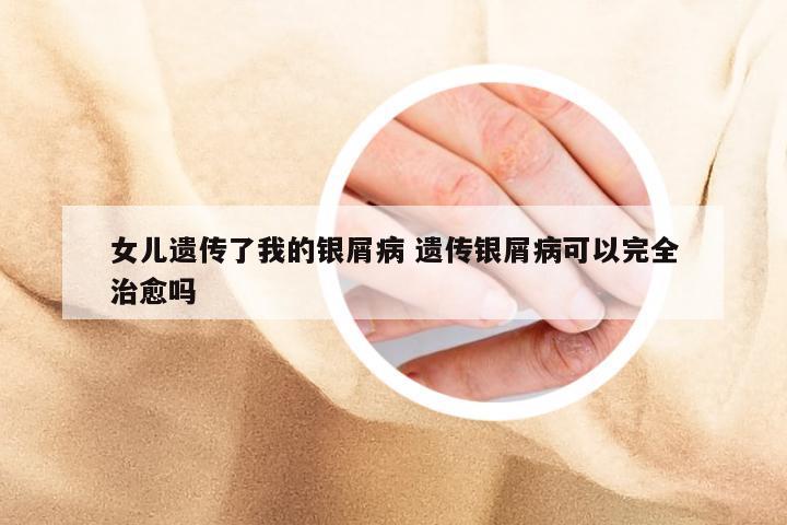 女儿遗传了我的银屑病 遗传银屑病可以完全治愈吗