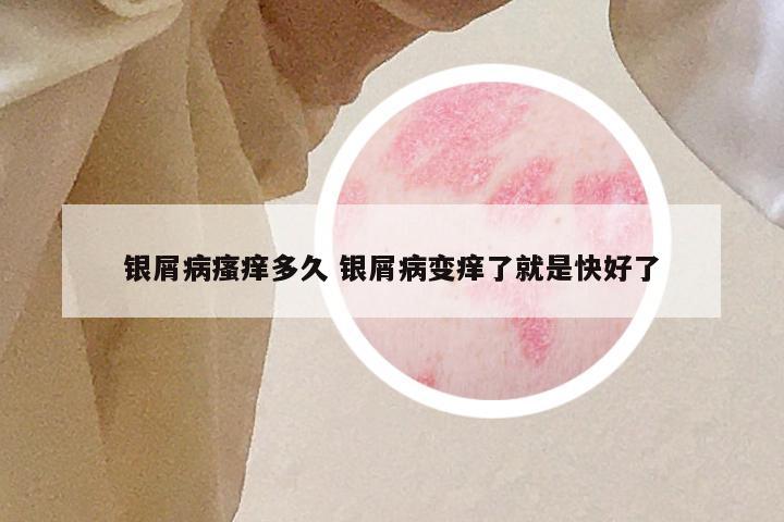 银屑病瘙痒多久 银屑病变痒了就是快好了