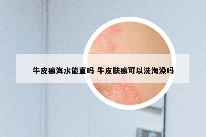 牛皮癣海水能直吗 牛皮肤癣可以洗海澡吗