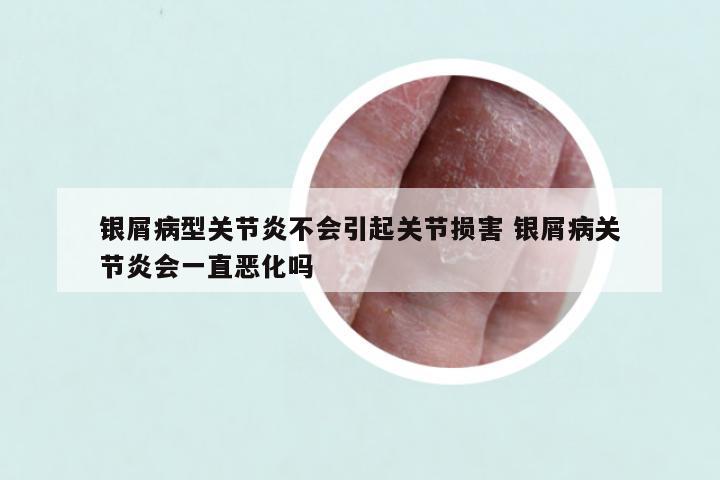 银屑病型关节炎不会引起关节损害 银屑病关节炎会一直恶化吗
