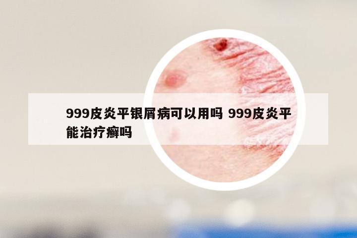 999皮炎平银屑病可以用吗 999皮炎平能治疗癣吗