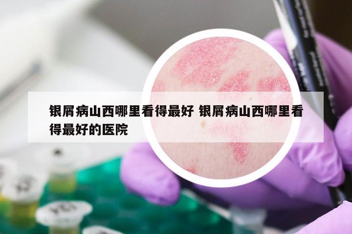 银屑病山西哪里看得最好 银屑病山西哪里看得最好的医院