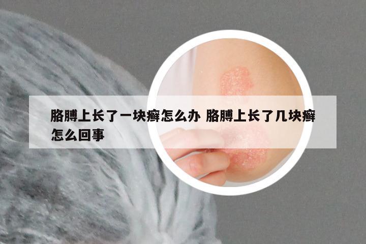 胳膊上长了一块癣怎么办 胳膊上长了几块癣怎么回事
