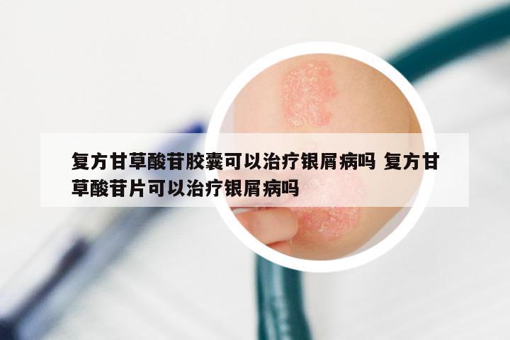 复方甘草酸苷胶囊可以治疗银屑病吗 复方甘草酸苷片可以治疗银屑病吗