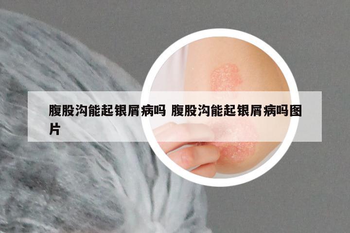 腹股沟能起银屑病吗 腹股沟能起银屑病吗图片