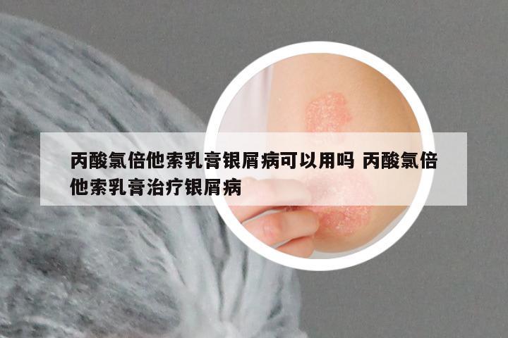 丙酸氯倍他索乳膏银屑病可以用吗 丙酸氯倍他索乳膏治疗银屑病