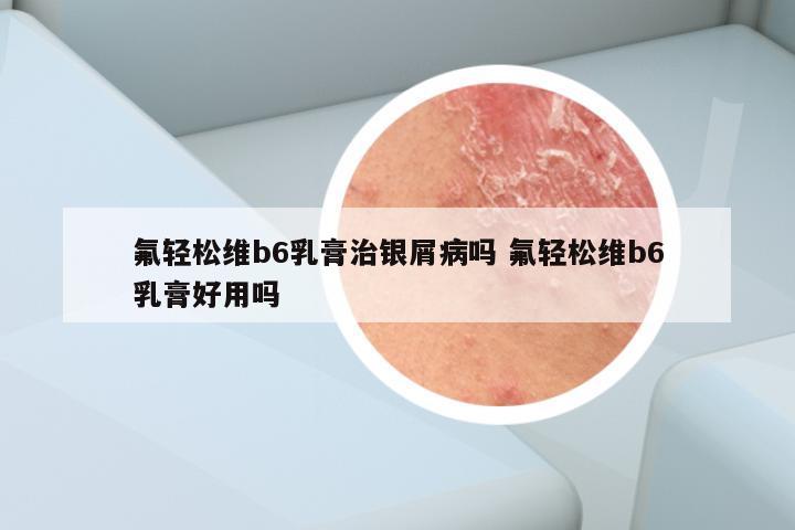 氟轻松维b6乳膏治银屑病吗 氟轻松维b6乳膏好用吗