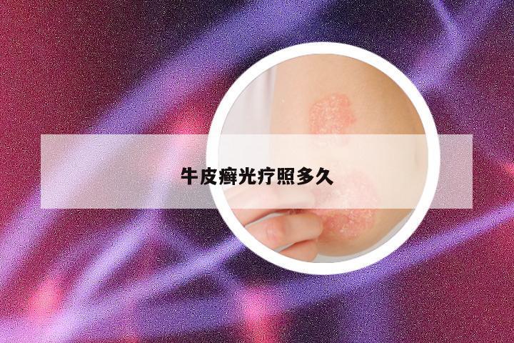 牛皮癣光疗照多久