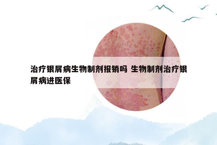 治疗银屑病生物制剂报销吗 生物制剂治疗银屑病进医保