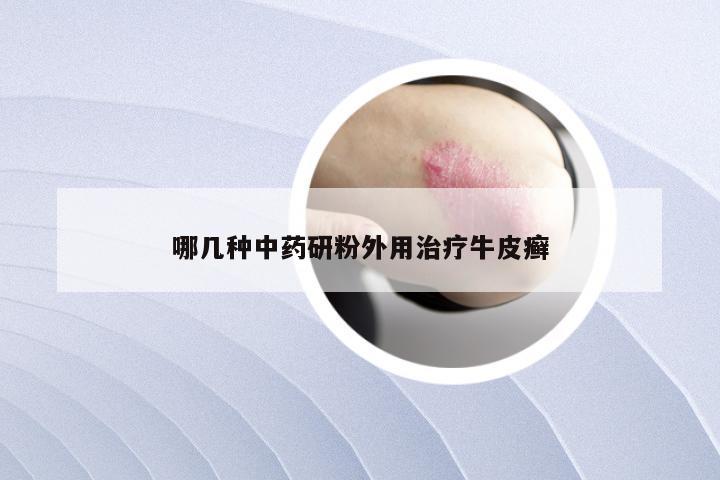 哪几种中药研粉外用治疗牛皮癣