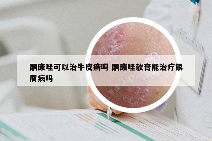 酮康唑可以治牛皮癣吗 酮康唑软膏能治疗银屑病吗