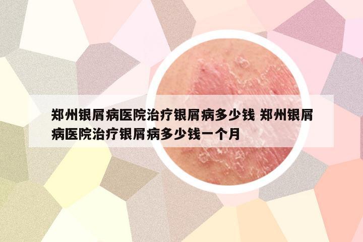 郑州银屑病医院治疗银屑病多少钱 郑州银屑病医院治疗银屑病多少钱一个月