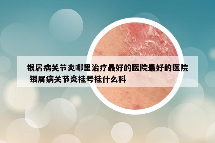 银屑病关节炎哪里治疗最好的医院最好的医院 银屑病关节炎挂号挂什么科