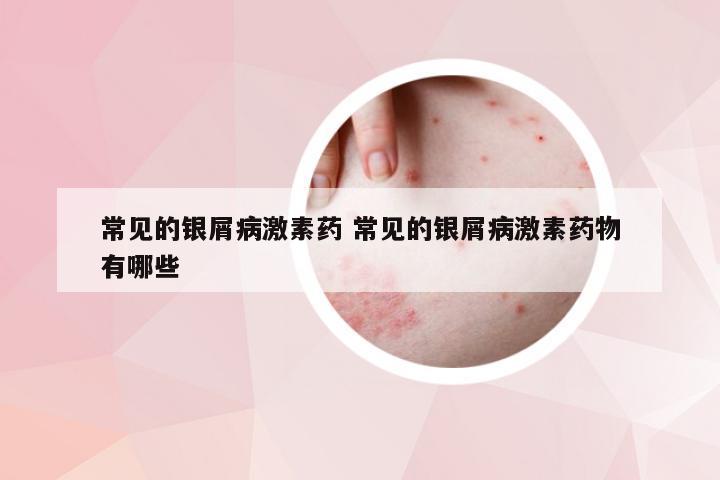 常见的银屑病激素药 常见的银屑病激素药物有哪些