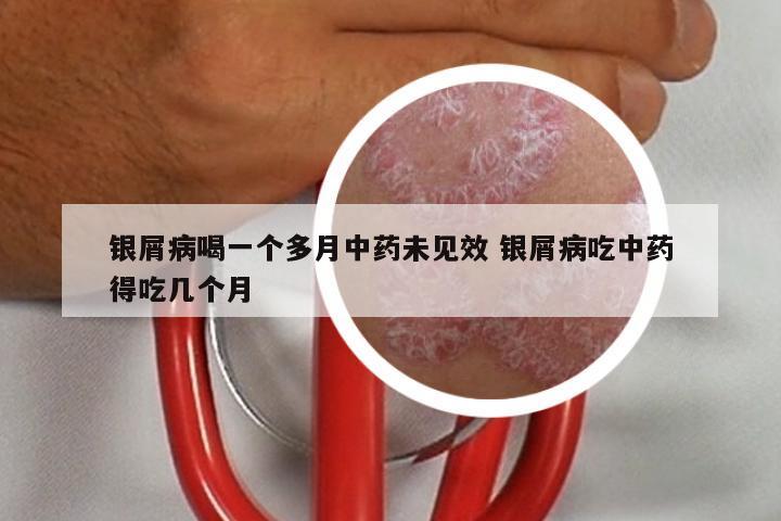 银屑病喝一个多月中药未见效 银屑病吃中药得吃几个月