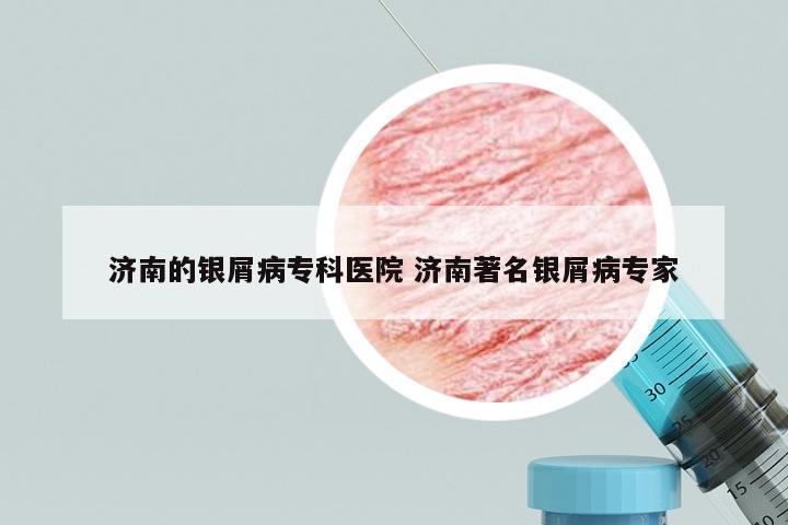 济南的银屑病专科医院 济南著名银屑病专家