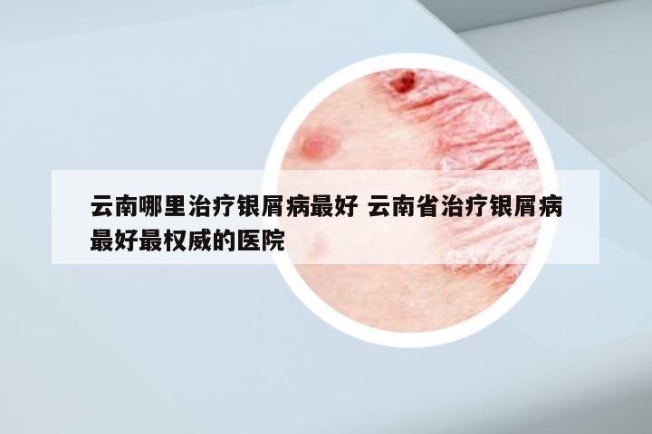 云南哪里治疗银屑病最好 云南省治疗银屑病最好最权威的医院
