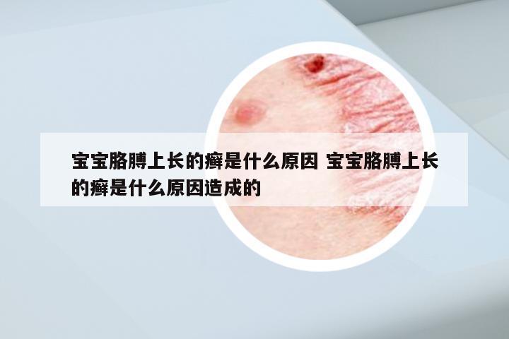 宝宝胳膊上长的癣是什么原因 宝宝胳膊上长的癣是什么原因造成的