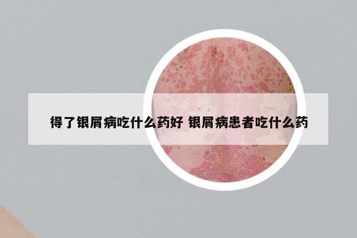 得了银屑病吃什么药好 银屑病患者吃什么药