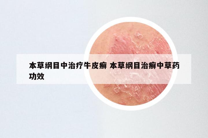 本草纲目中治疗牛皮癣 本草纲目治癣中草药功效
