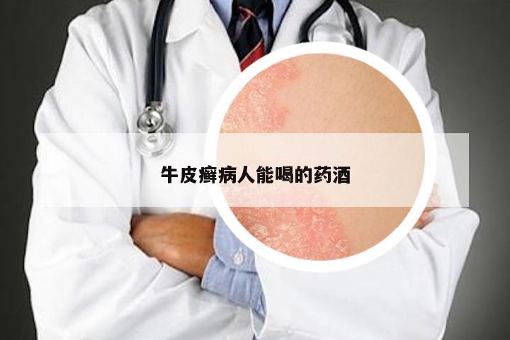 牛皮癣病人能喝的药酒