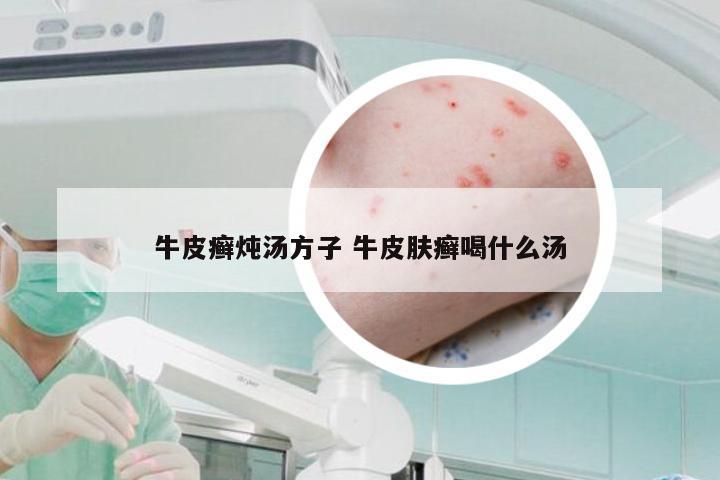 牛皮癣炖汤方子 牛皮肤癣喝什么汤