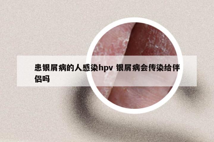 患银屑病的人感染hpv 银屑病会传染给伴侣吗