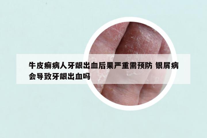 牛皮癣病人牙龈出血后果严重需预防 银屑病会导致牙龈出血吗