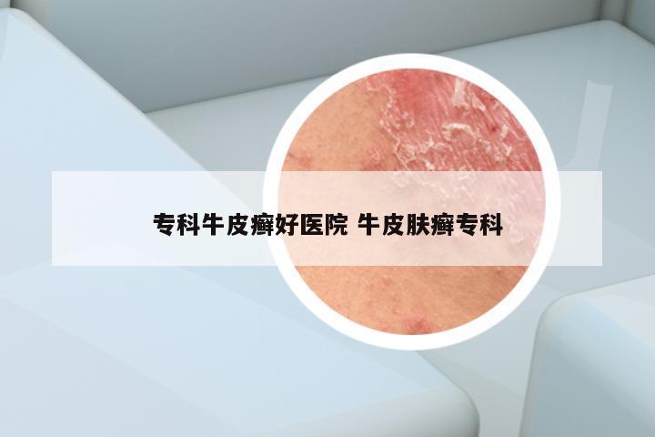 专科牛皮癣好医院 牛皮肤癣专科