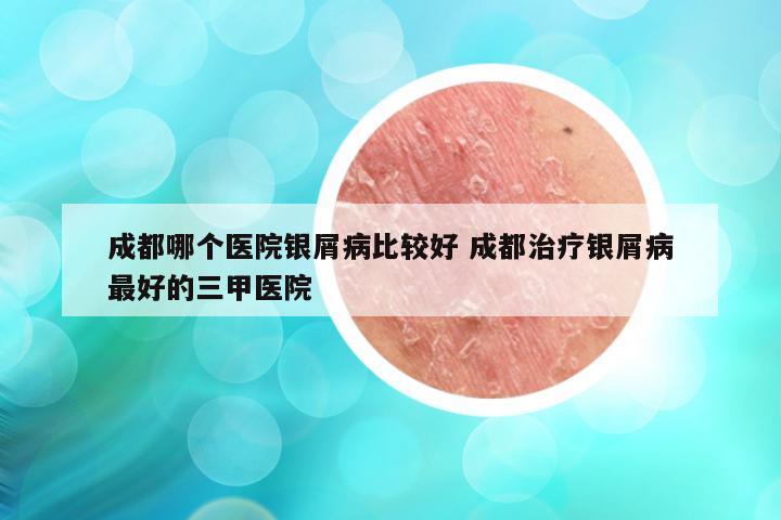 成都哪个医院银屑病比较好 成都治疗银屑病最好的三甲医院