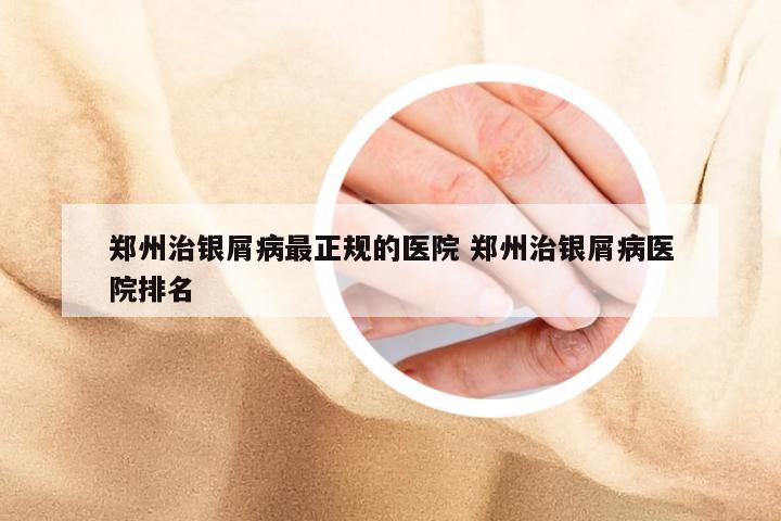 郑州治银屑病最正规的医院 郑州治银屑病医院排名