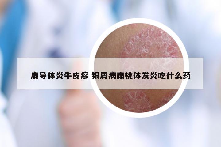 扁导体炎牛皮癣 银屑病扁桃体发炎吃什么药