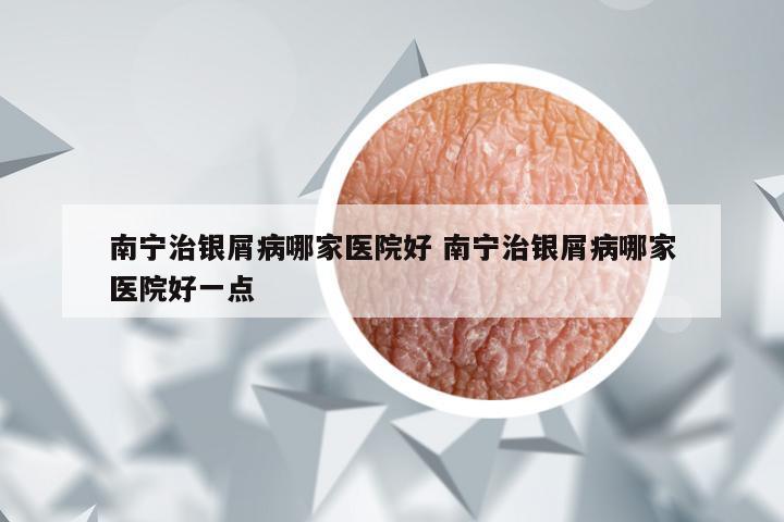 南宁治银屑病哪家医院好 南宁治银屑病哪家医院好一点
