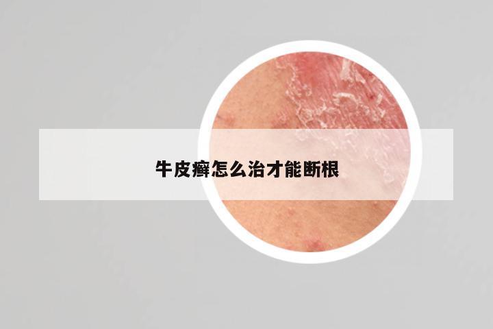 牛皮癣怎么治才能断根