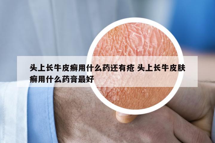 头上长牛皮癣用什么药还有疮 头上长牛皮肤癣用什么药膏最好
