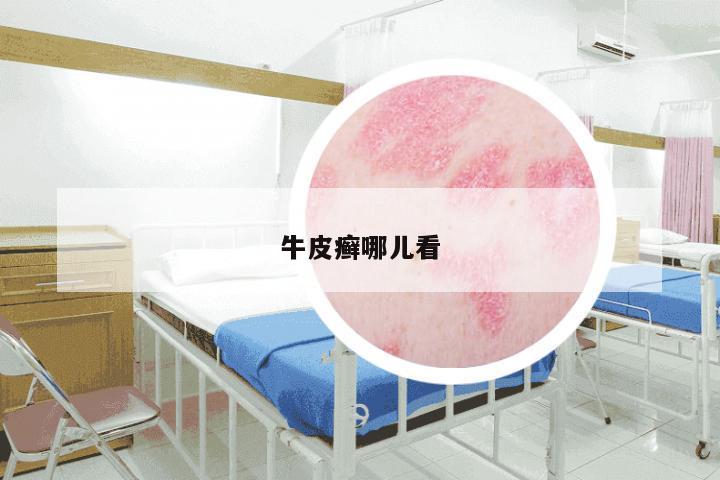 牛皮癣哪儿看