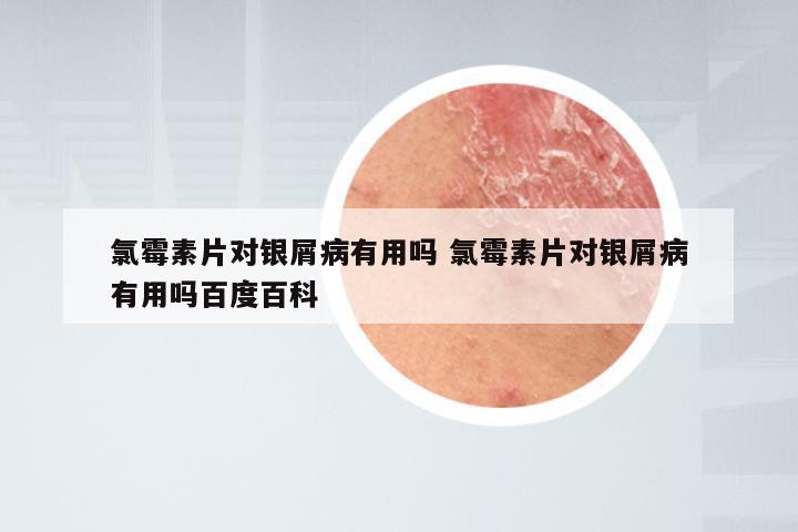 氯霉素片对银屑病有用吗 氯霉素片对银屑病有用吗百度百科
