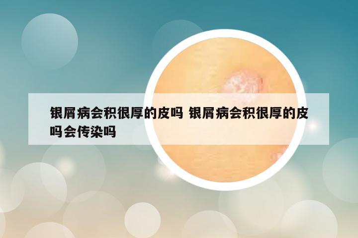银屑病会积很厚的皮吗 银屑病会积很厚的皮吗会传染吗