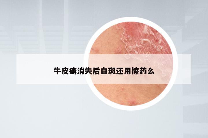 牛皮癣消失后白斑还用擦药么