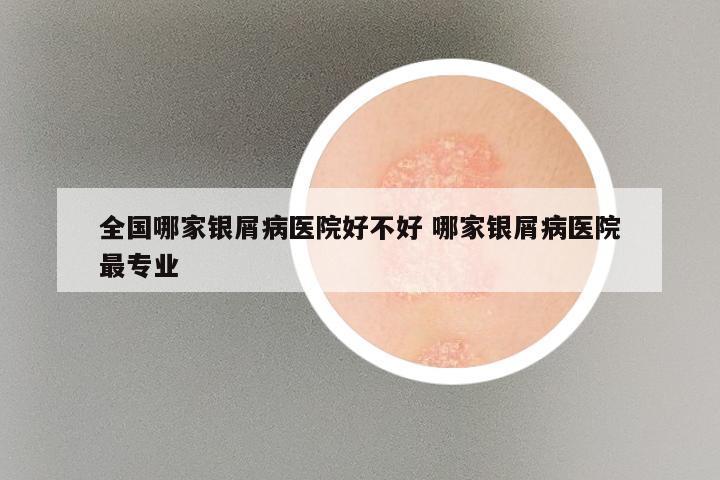 全国哪家银屑病医院好不好 哪家银屑病医院最专业