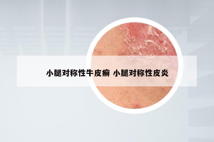 小腿对称性牛皮癣 小腿对称性皮炎