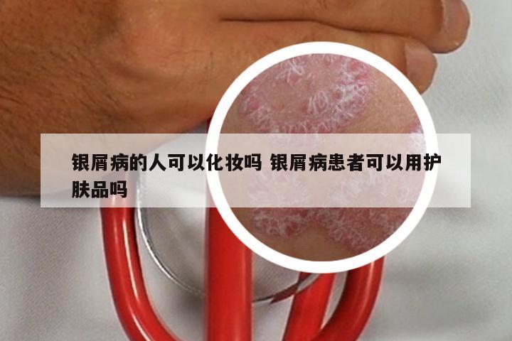 银屑病的人可以化妆吗 银屑病患者可以用护肤品吗