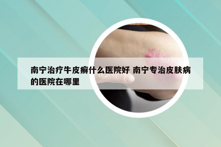 南宁治疗牛皮癣什么医院好 南宁专治皮肤病的医院在哪里