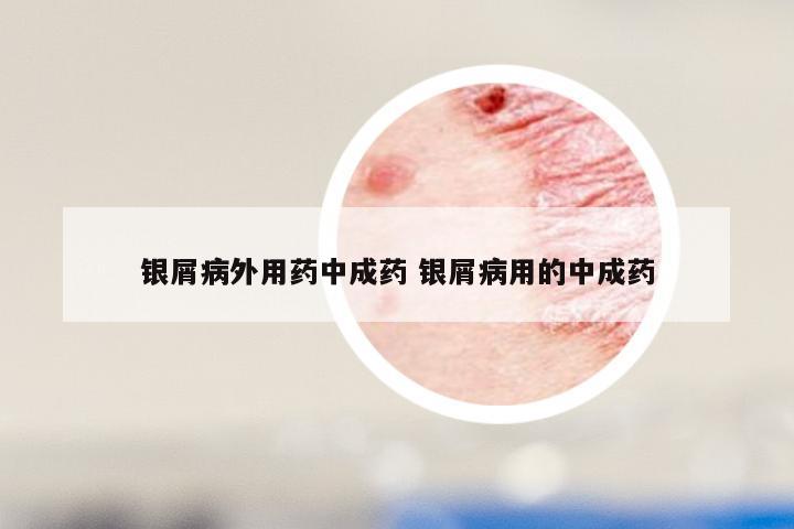 银屑病外用药中成药 银屑病用的中成药