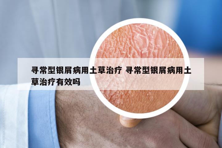 寻常型银屑病用土草治疗 寻常型银屑病用土草治疗有效吗