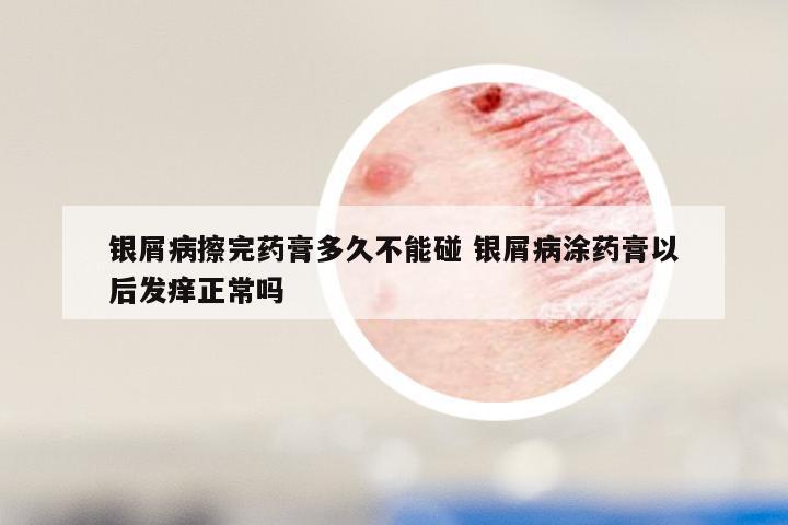 银屑病擦完药膏多久不能碰 银屑病涂药膏以后发痒正常吗