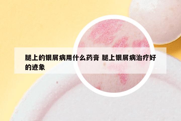 腿上的银屑病用什么药膏 腿上银屑病治疗好的迹象