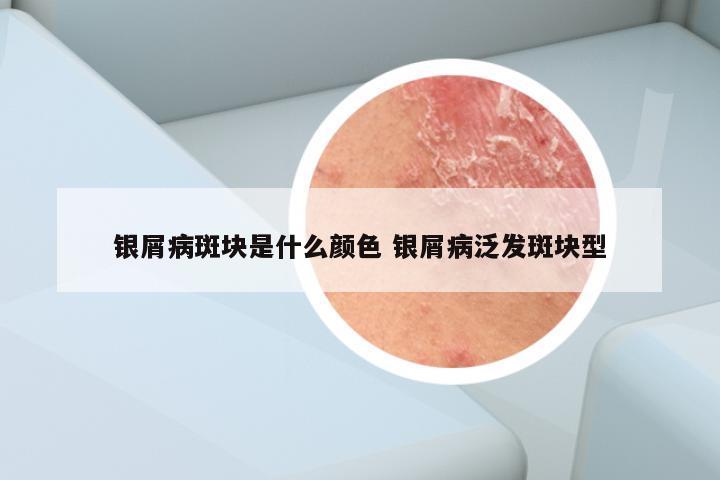 银屑病斑块是什么颜色 银屑病泛发斑块型