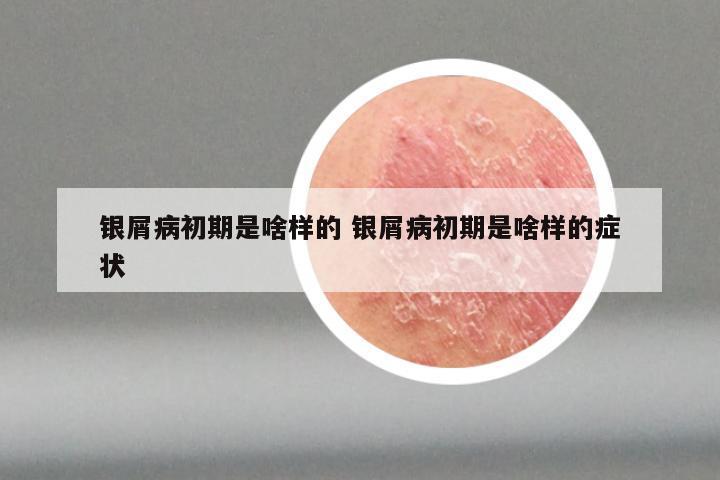 银屑病初期是啥样的 银屑病初期是啥样的症状